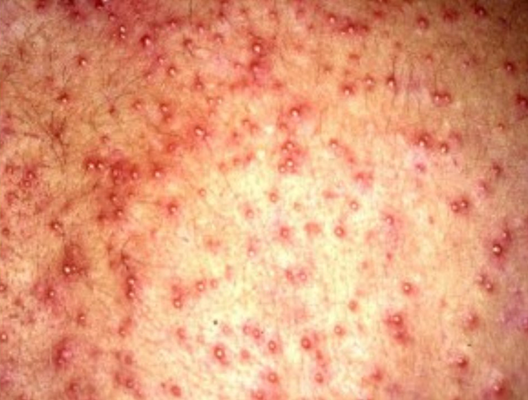 湿疹 乾燥肌 あせも 中毒疹 薬疹 高田馬場皮膚科 形成外科